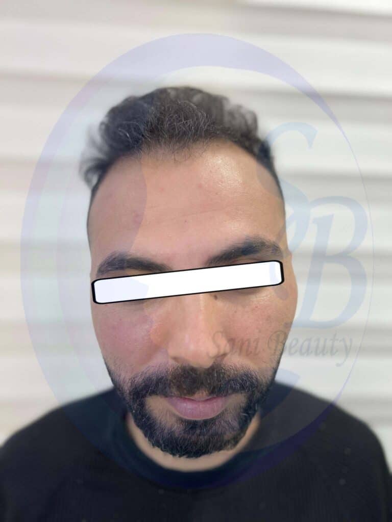 تصویر مربوط به قبل از عمل کاشت مو میباشد