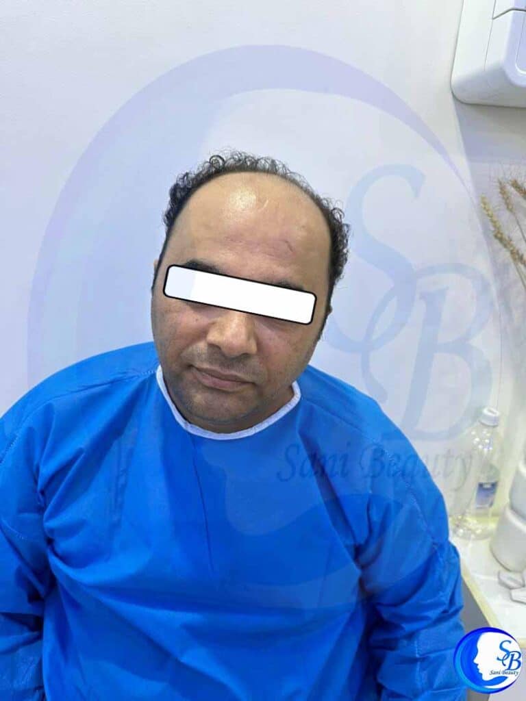 تصویر مربوط به قبل از عمل کاشت مو میباشد