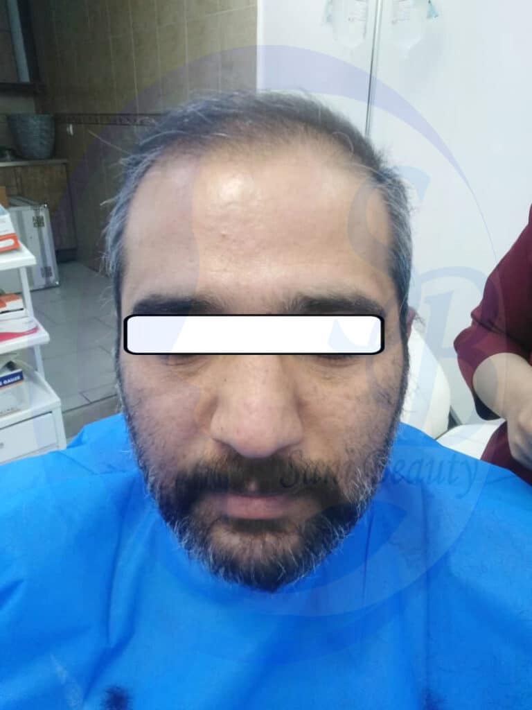تصویر مربوط به قبل از عمل کاشت مو میباشد