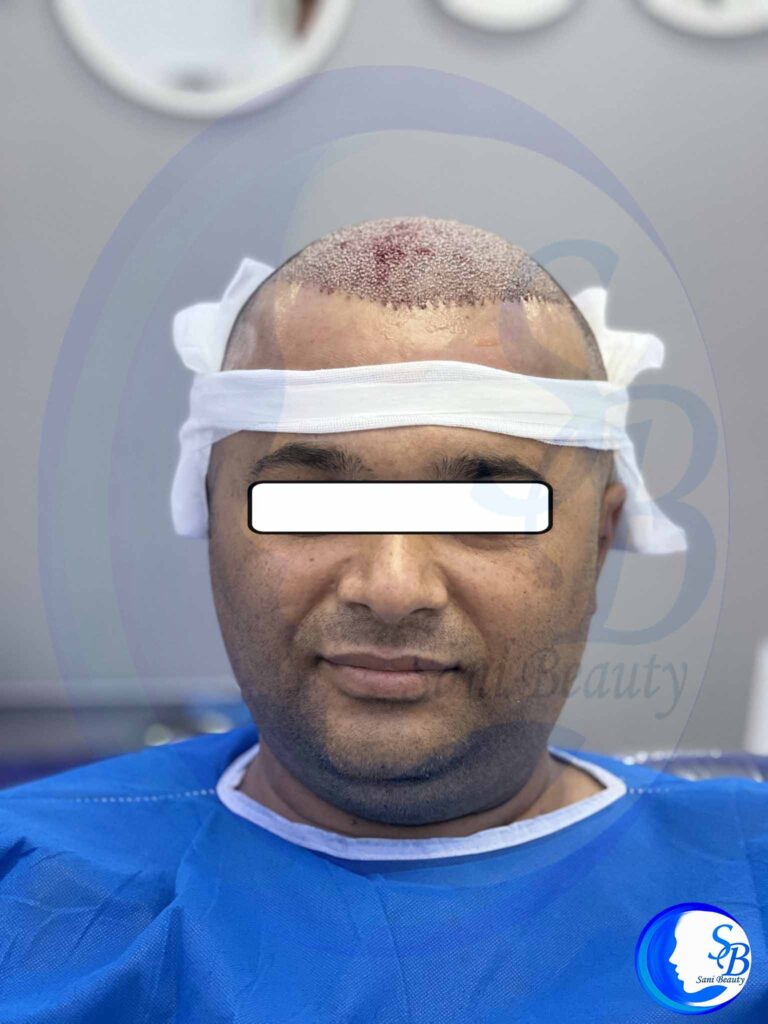 کاشت 8000 هزار تار مو، تصویر بعد از عمل کاشت مو