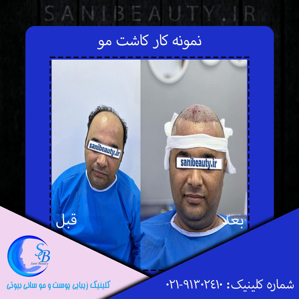 نمونه کار کاشت مو در کلینیک پوست و مو سانی بیوتی