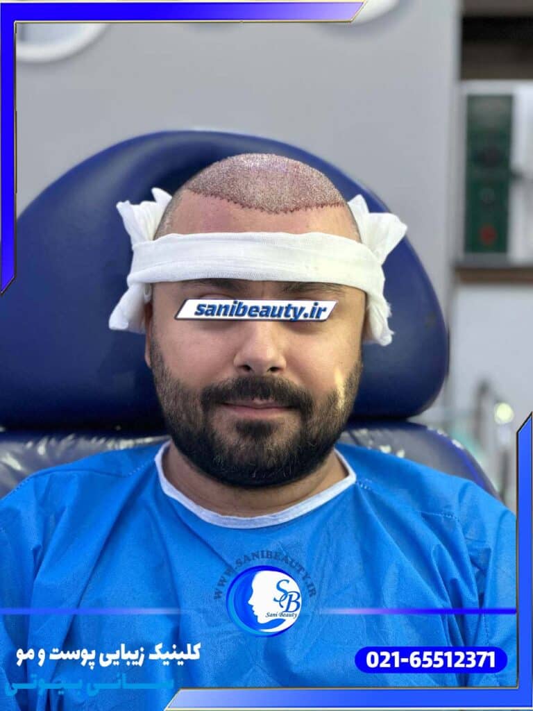 کاشت 5000 هزار تار مو، تصویر بعد از عمل کاشت مو