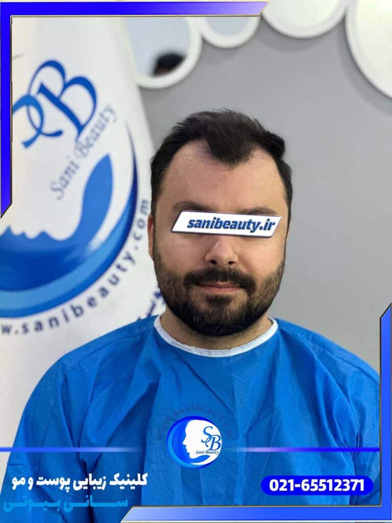 تصویر مربوط به قبل از عمل کاشت مو میباشد