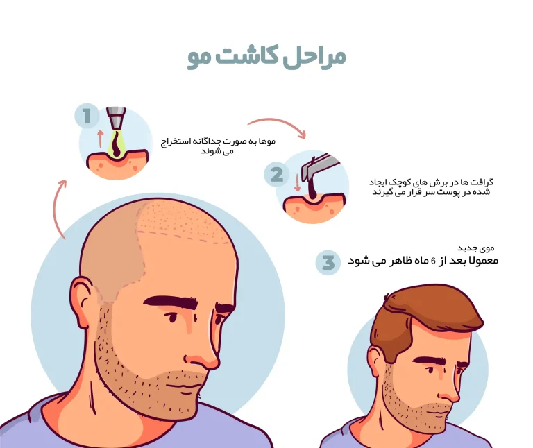 کاشت مو اندیشه