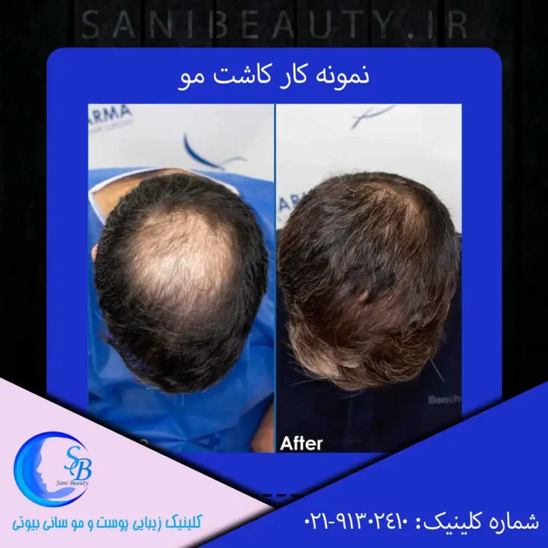 نمونه کار کاشت مو