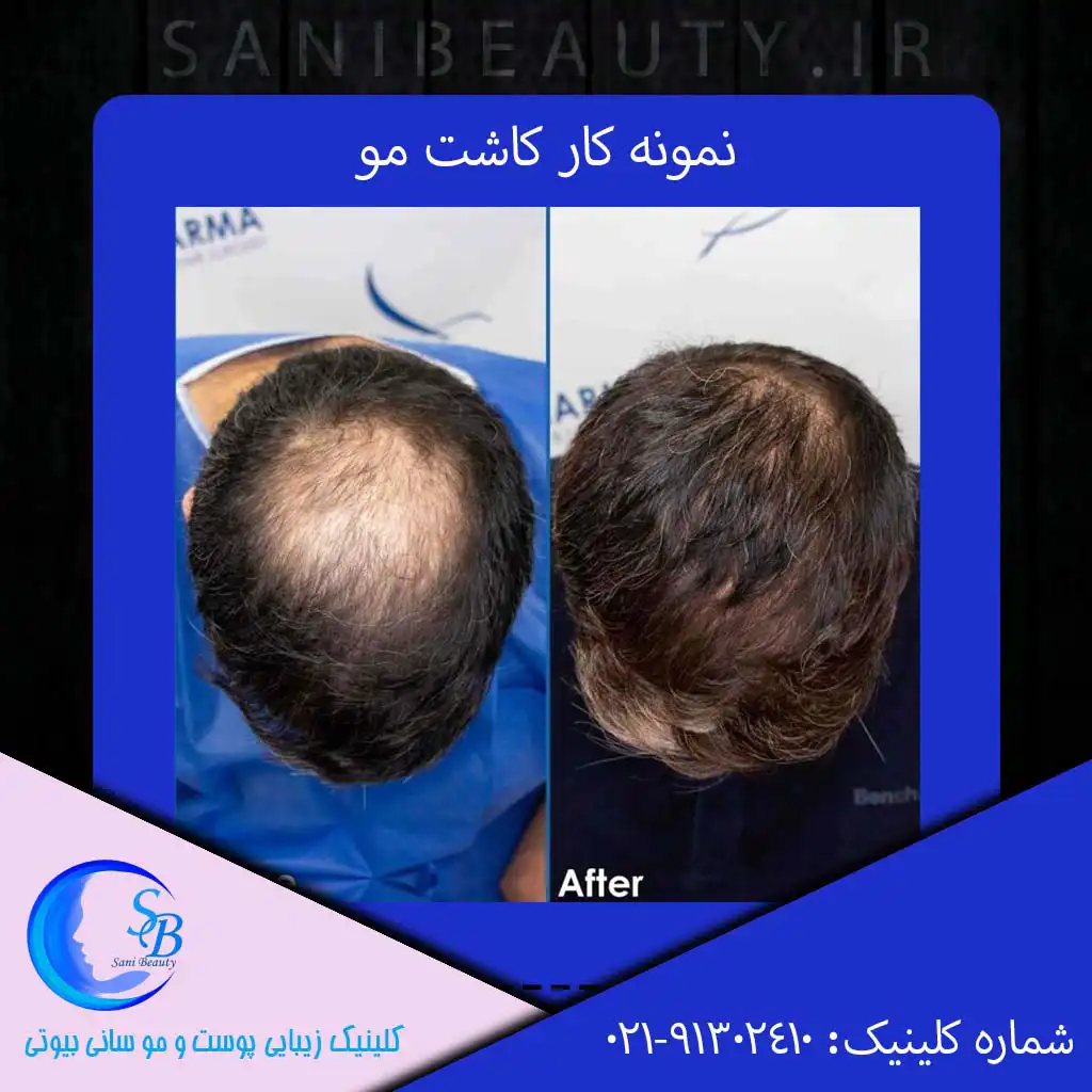 نمونه کار کاشت مو