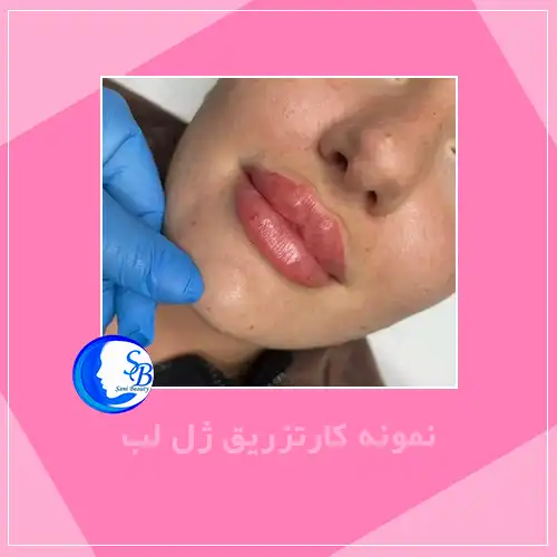 نمونه کار تزریق ژل لب در اندیشه