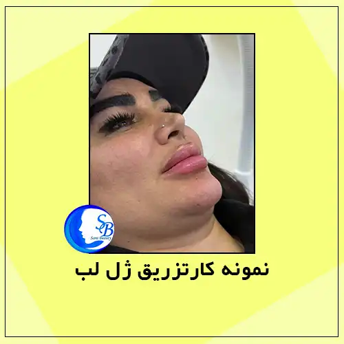 نمونه کار تزریق ژل لب در اندیشه | کلینیک سانی بیوتی