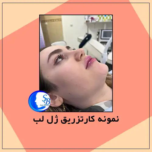 نمونه کار تزریق ژل لب در اندیشه | کلینیک سانی بیوتی