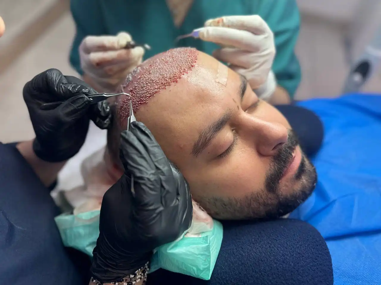 کاشت مو در اندیشه