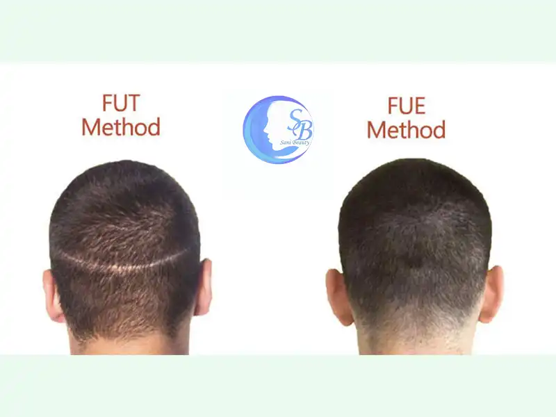 کاشت مو به روش fue و fut