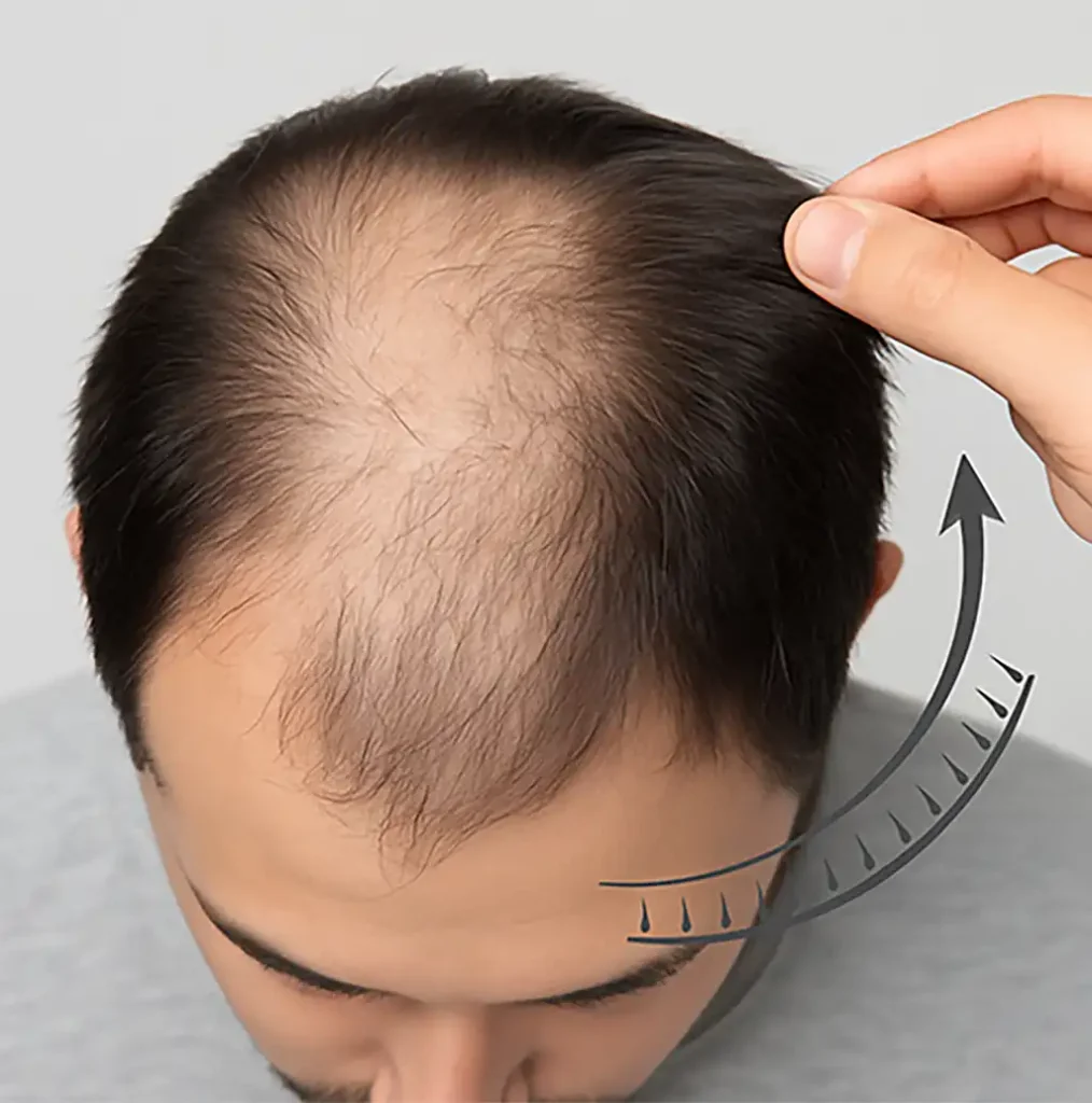 کاشت مو در اندیشه