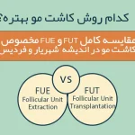 کدوم روش کاشت مو بهتره؟ مقایسه کامل FUE و FUT مخصوص اندیشه، شهریار و فردیس!