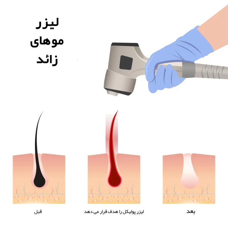 laser hair removal