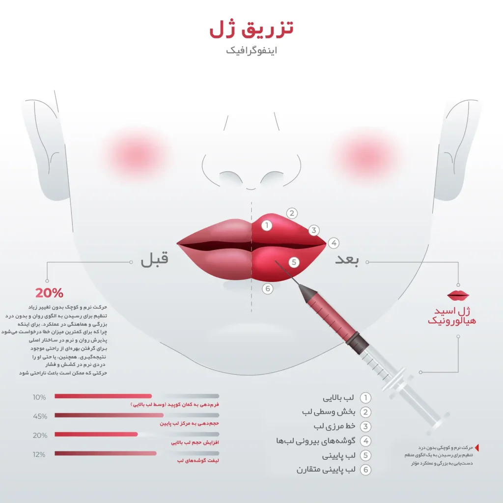 مراحل انجام تزریق ژل و فیلر در کلینیک سانی بیوتی اندیشه