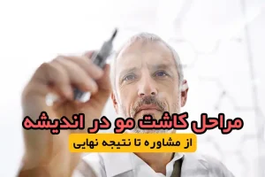 کاشت مو در اندیشه