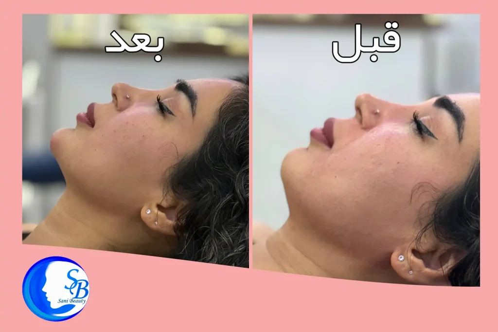 قبل و بعد از زاویه‌سازی فک با ژل در کلینیک سانی بیوتی اندیشه