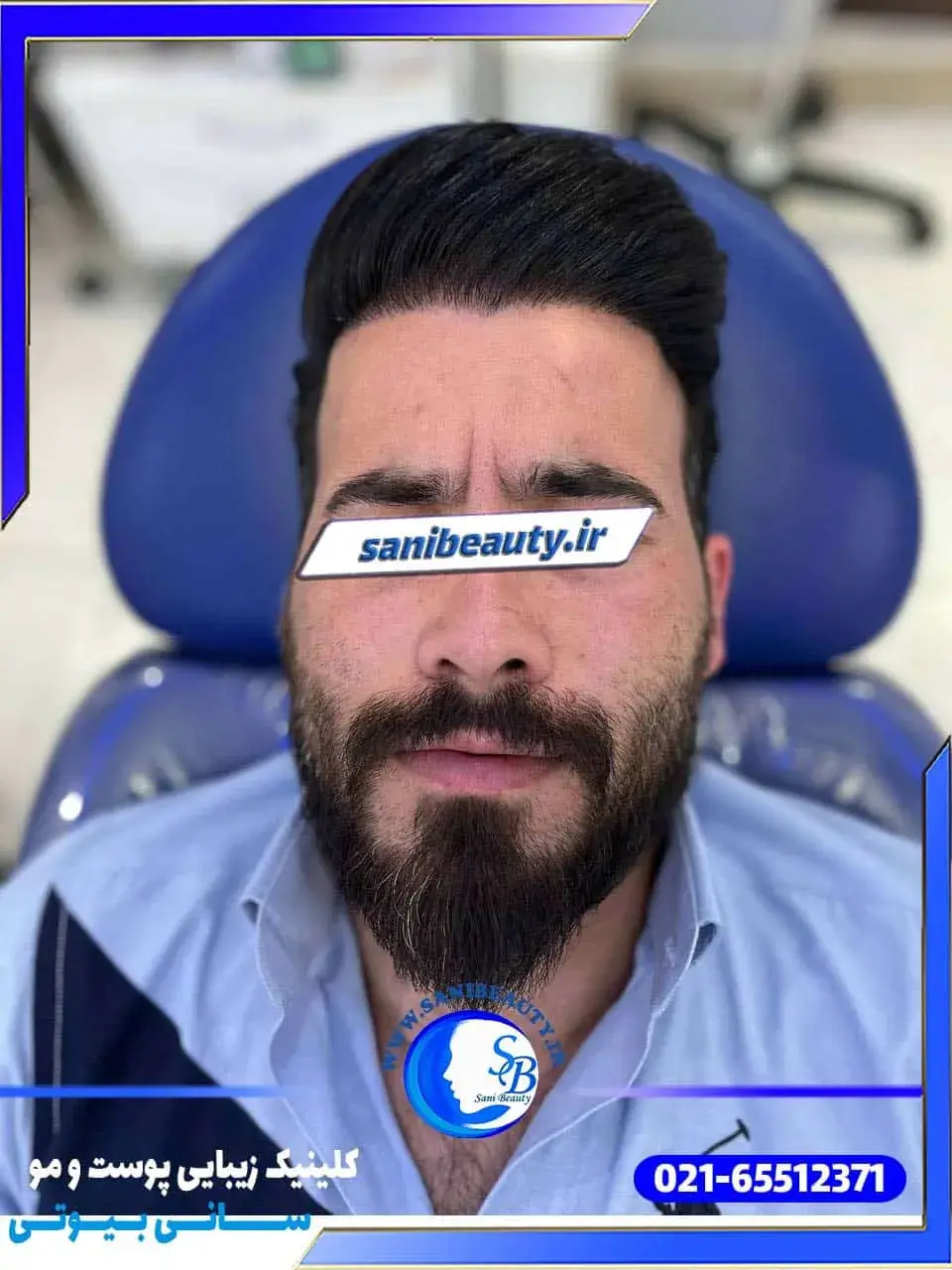 بوتاکس